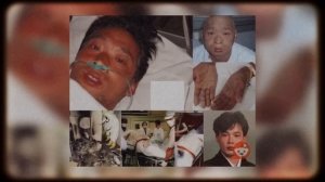 83 ДНЯ АДА В БОЛЬНИЦЕ | ОН ОСТАЛСЯ БЕЗ КОЖИ