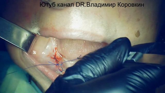 Узловые швы. Вязание на инструменте , иглодержатель Кастельвьексо.кейс.#1. смотреть онлайн