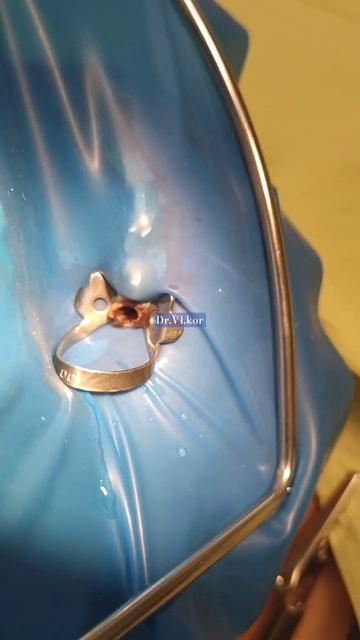 Изменение геометрии клампа 00. V-образный профиль шек. О смотреть онлайн