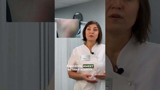 Разница между стержневыми мозолями и бородавками смотреть онлайн