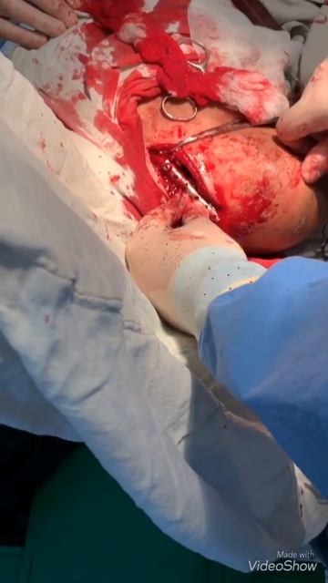 CLAVICLE fracture operation- Операция перелома ключицы смотреть онлайн
