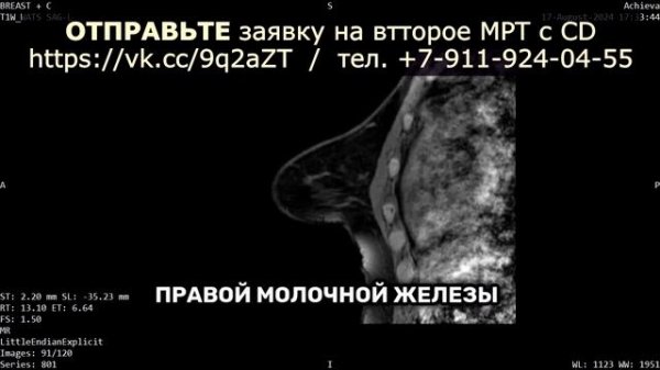 КИСТА молочной железы BI RADS 2 БОЛЯТ молочные железы акс