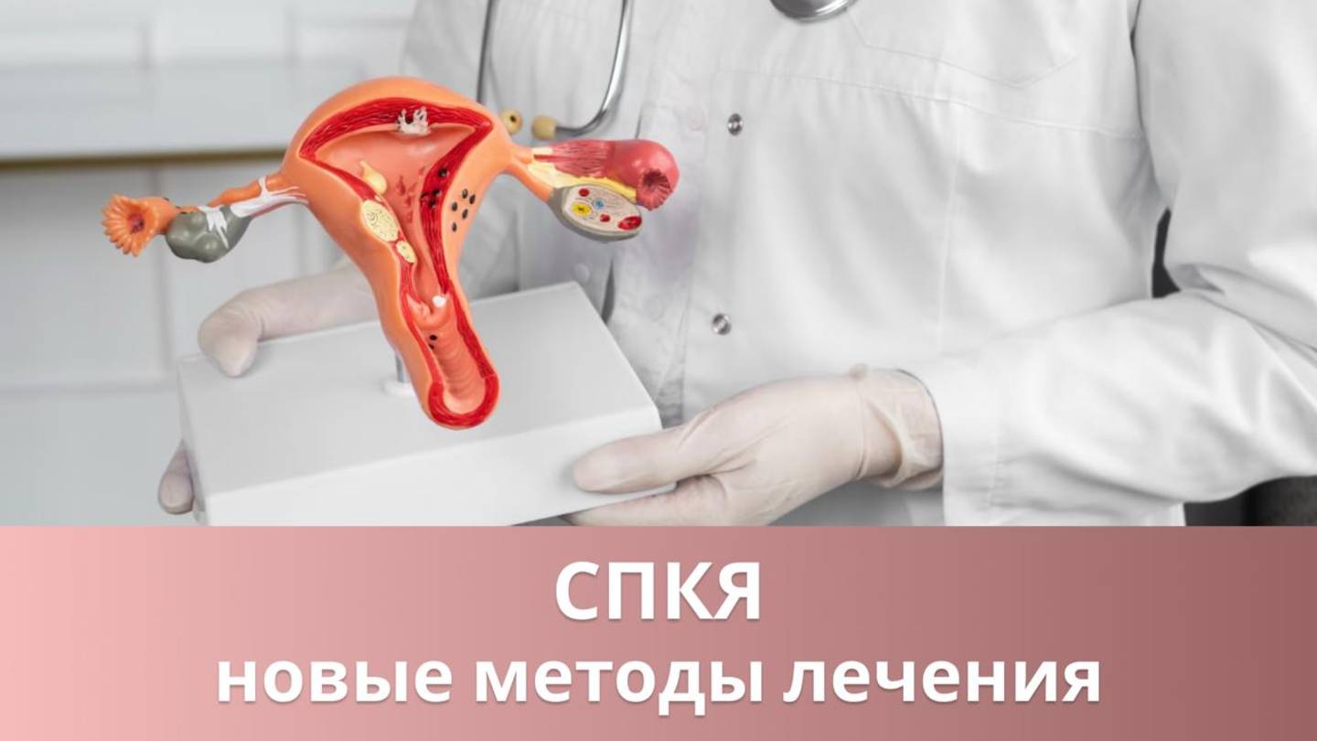 🔎 Как лечат синдром поликистозных яичников в 2025 году? смотреть онлайн