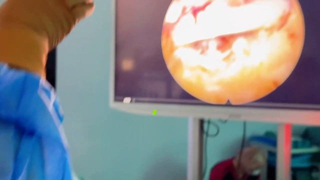 Грыжа L4-L5 смотреть онлайн