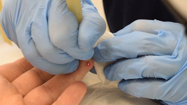 Удаление бородавок лазером - показ процедуры. Третяк М