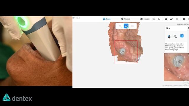 Интраоральный 3D-сканер Runyes IOS-11. Обзор реального кейса смотреть онлайн