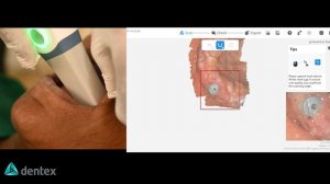 Интраоральный 3D-сканер Runyes IOS-11. Обзор реального кейса