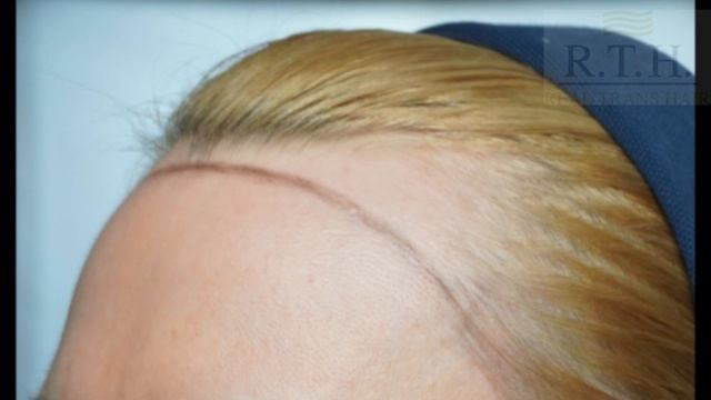 Мужская линия роста волос у женщин или височные залысины! смотреть онлайн