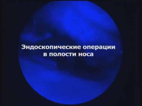 Эндоскопические операции в полости носа