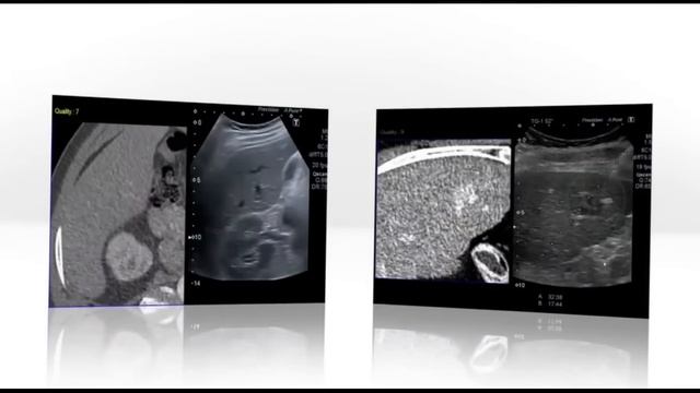 Огляд апарата УЗД Toshiba Aplio 500