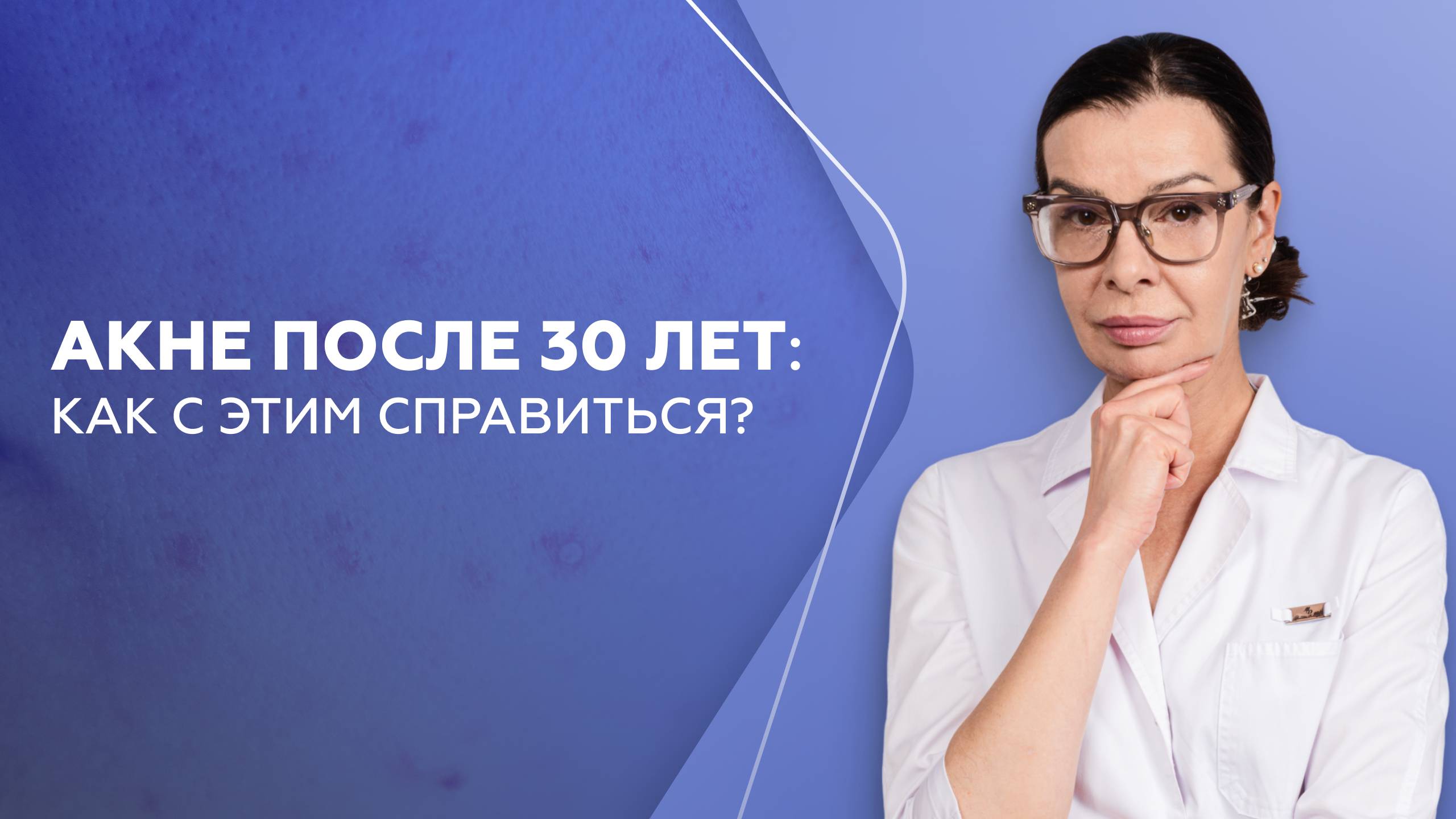 Как справиться с акне после 30 лет? смотреть онлайн