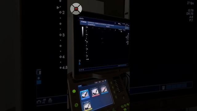 Обзор Toshiba Aplio 500 | Мощный УЗИ аппарат с высокой детал? смотреть онлайн