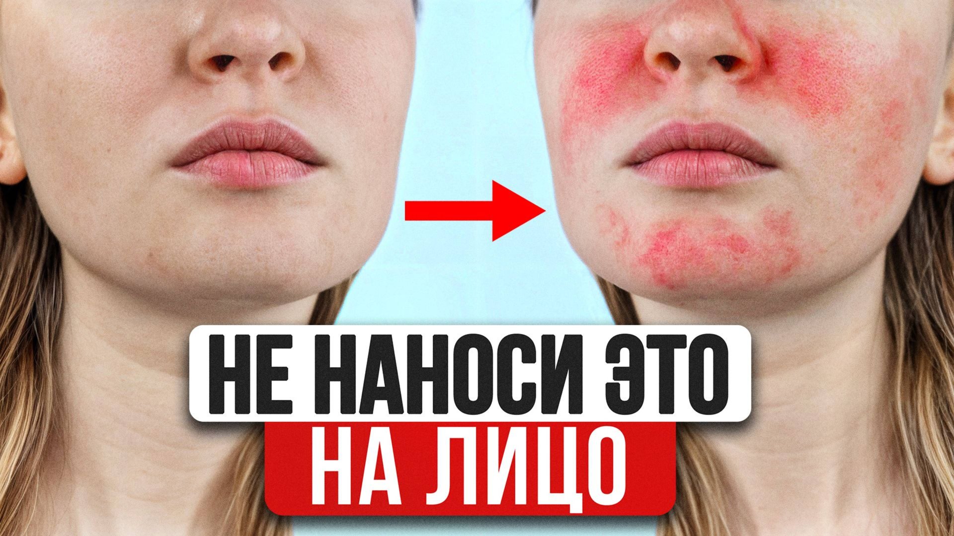 СПАСИ СВОЮ КОЖУ! Как побороть зависимость от гормональных мазей БЕЗ ПОСЛЕДСТВИЙ? смотреть онлайн