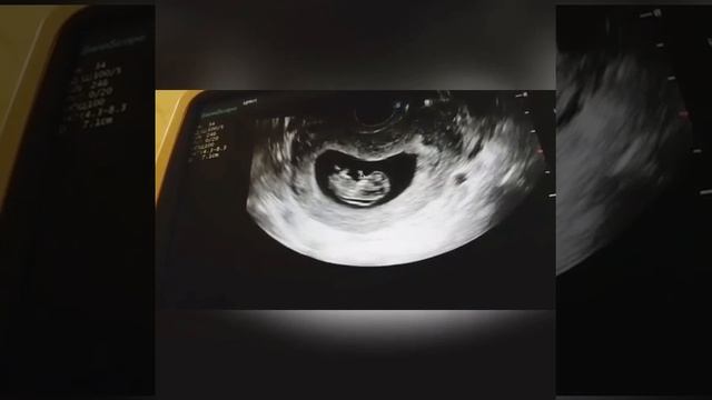 УЗИ ЭКО в 40 лет смотреть онлайн