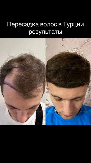 Пересадка волос в Турции результаты #worbimed