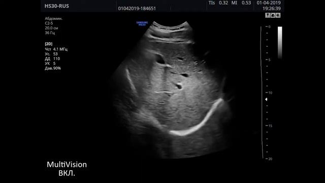 Скринінговий УЗ апарат Samsung HS30 смотреть онлайн