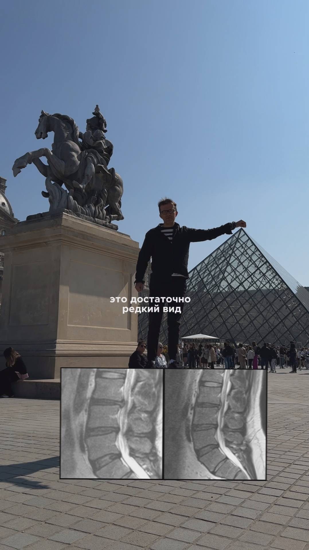 Редкий вид грыжи диска.