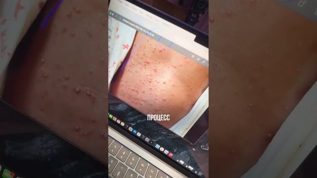 Как отличить акне от… смотреть онлайн