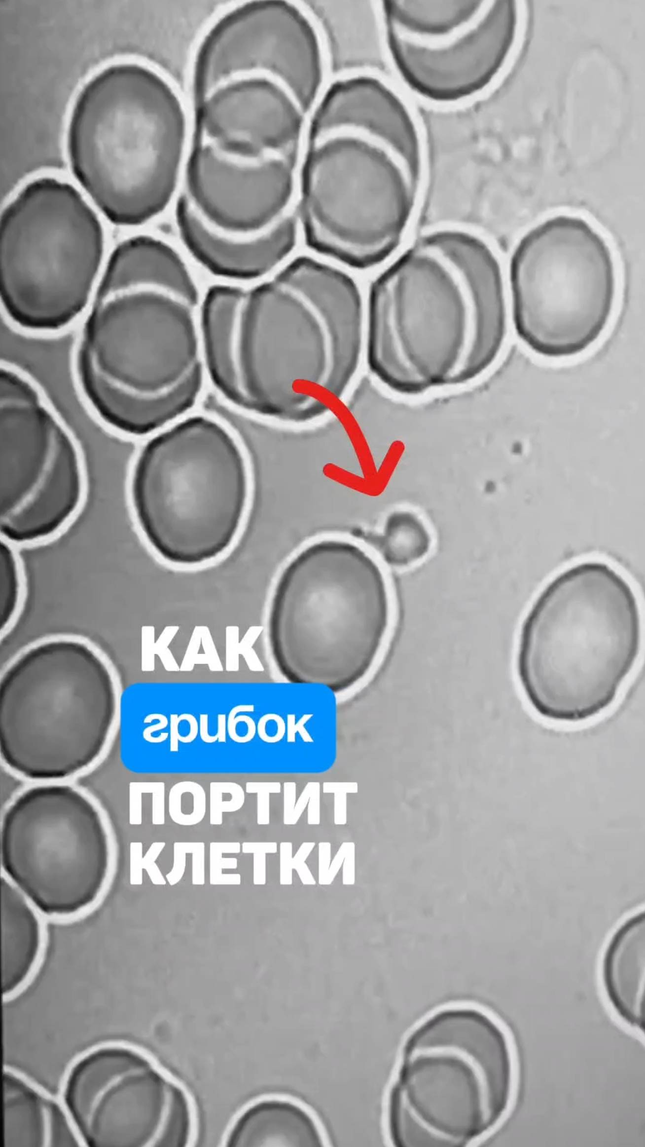 Как грибок портит клетки. Кандида в крови. Алена Братишко смотреть онлайн