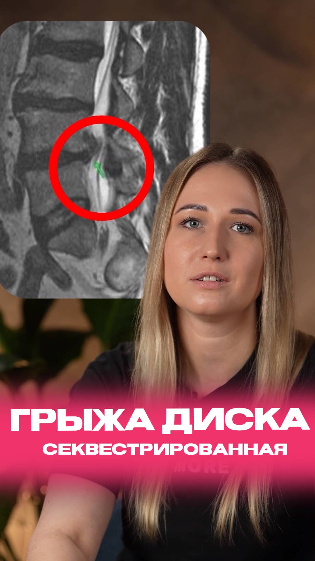 Секвестрированная грыжа позвоночника.