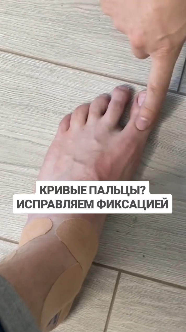 Если у вас кривятся пальцы - Фиксируем стопу в обуви в правильную геометрию смотреть онлайн
