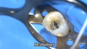 Извлечение сломанного инструмента из корневого канал