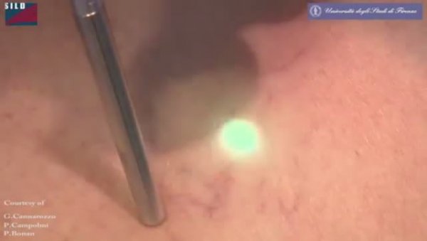 Удаление сосудов DEKA NdYAG лазер Motus AY