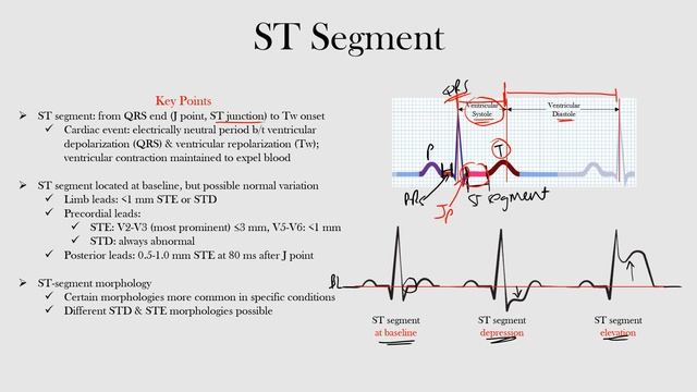 21.ST Segment
