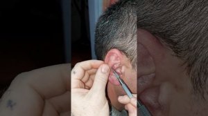 аурикулярная диагностика. выявление деструктивных пр