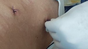 Удаление дренажной трубки  Студент 403 группы Болтаев С