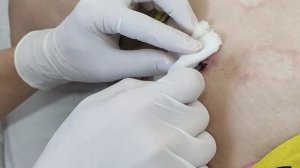 Удаление дренажной трубки  Студент 403 группы Адхамова