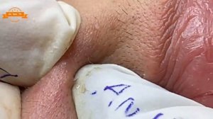 Удаление прыщей с щек и носа.