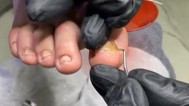 Ошибки при установке  ТИТАНОВОЙ НИТИ  . #титановаянить