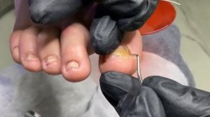 Ошибки при установке  ТИТАНОВОЙ НИТИ  . #титановаянить