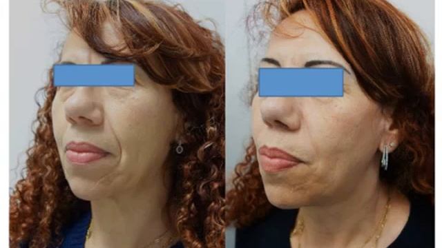 Ultraformer 2 Effect До и после