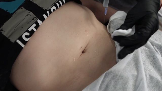 мезотерапия живот