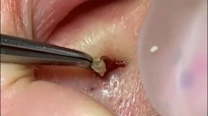 New Blackhead profesional extraction   Выдавливание черных точек прыще?
