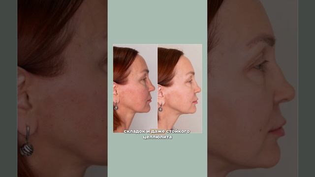 RF-лифтинг. Разница между аппаратами Virtue RF и Morpheus8