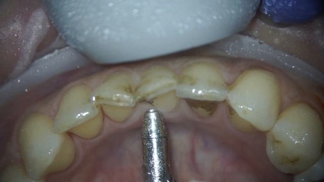 Чистка зубов удаление зубного налета и зубного камня # смотреть онлайн