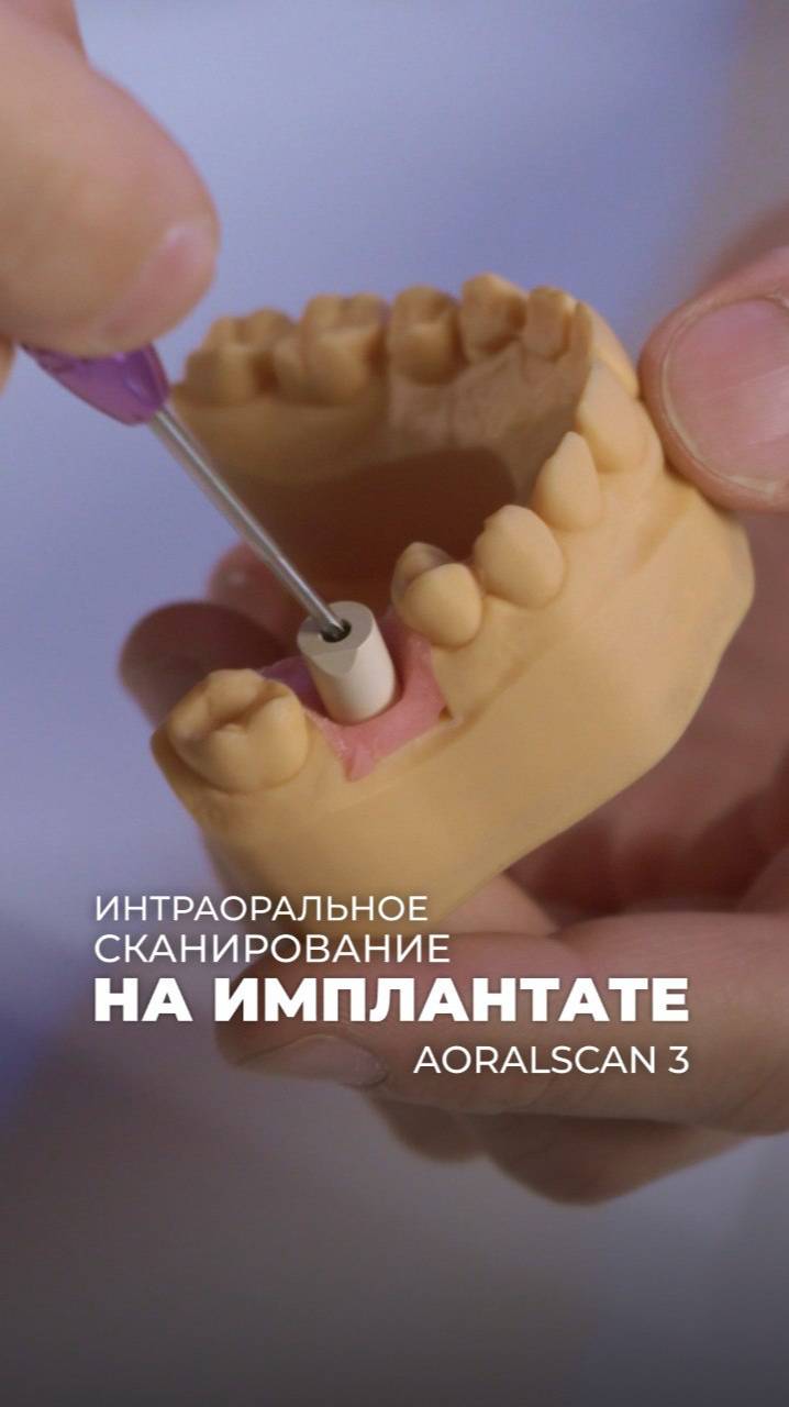 Сканирование с уровня имплантата с помощью сканмаркера смотреть онлайн