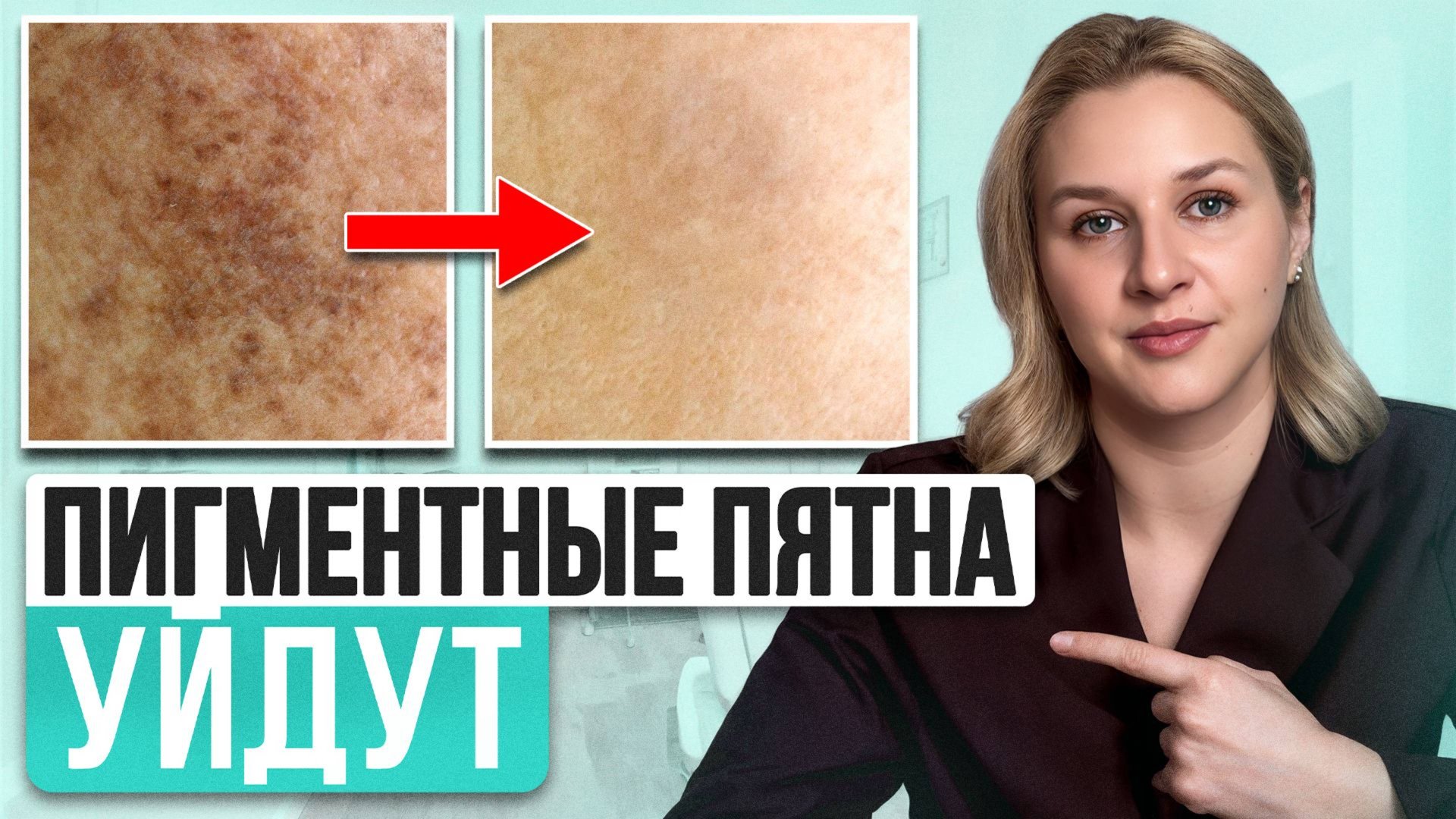 Самые ЛУЧШИЕ средства от пигментных пятен на лице! Как быстро вылечить гиперпигментацию? смотреть онлайн
