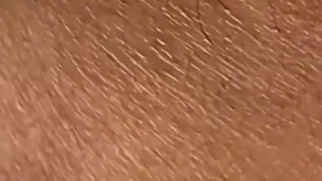 Прыщи / Огромные прыщи / Релакс с акне / Выдавливание пр