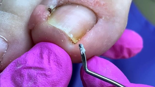 Вросший ноготь - воспалился палец! (Часть 2) Результат с смотреть онлайн