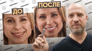 Реальный отзыв о установке виниров! Сделала виниры и пожалела...  Стоит ли ставить виниры? Цены