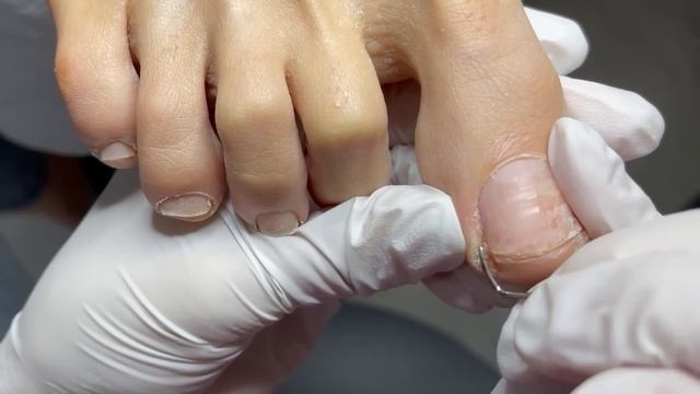 Гигантская Подногтевая Мозоль😱 #Нейл78 #педикюр #мозо? смотреть онлайн