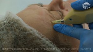 ✅ КАРБОКСИТЕРАПИЯ - процедура введения углекислого г?