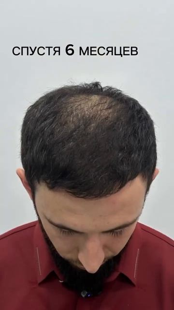 Первы этап пересадки спустя полгода 🤩🤩 смотреть онлайн