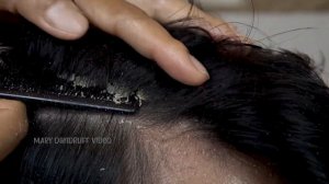 Царапины от перхоти большими хлопьями #853