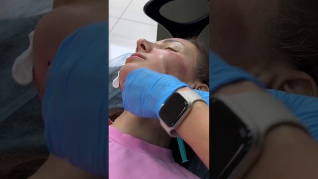 Eldermafill. Нижняя треть лица. IN AC ZN , HTL-T, DMAE Lift