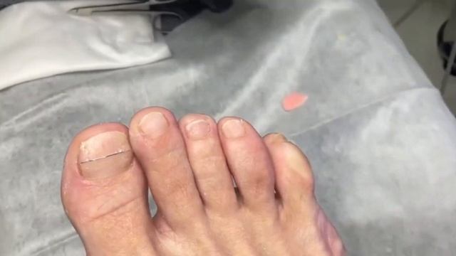 Обработка межпальцевой мозоли. #подология #подолог #мо